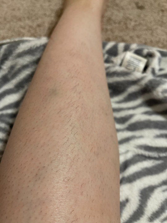 5MINSKIN AT-HOME LASER HAIR REMOVAL HANDSET