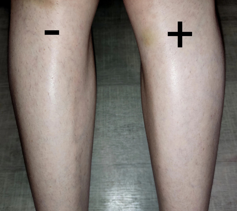 5MINSKIN AT-HOME LASER HAIR REMOVAL HANDSET