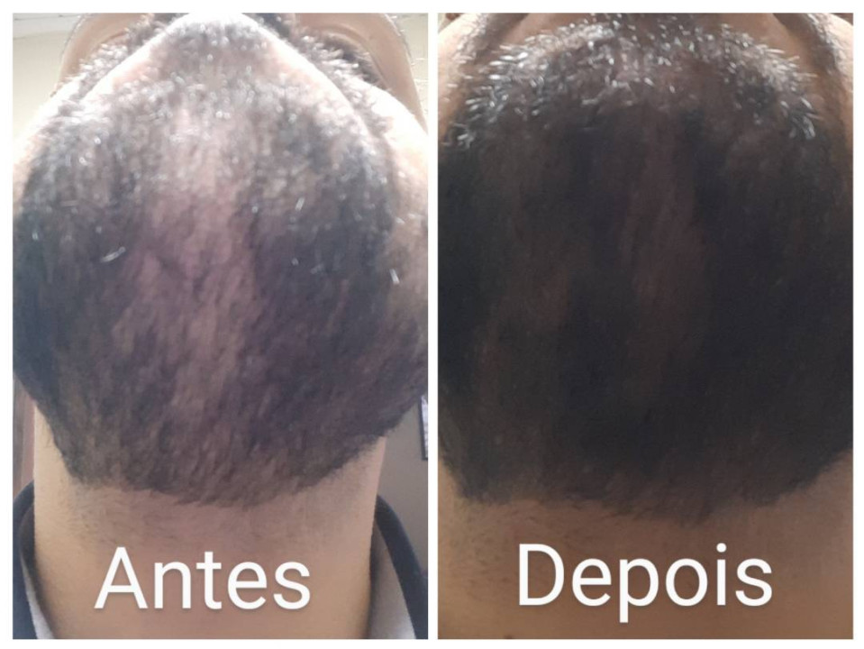 Barba de cliente antes e depois do Preenchedor Barba Robusta